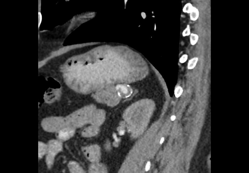 File:Bilateral urolithiasis with incidentally detected splenic artery aneurysm and left inferior vena cava (Radiopaedia 44467-48127 Ob. Sag. C+ Art. 24).jpg