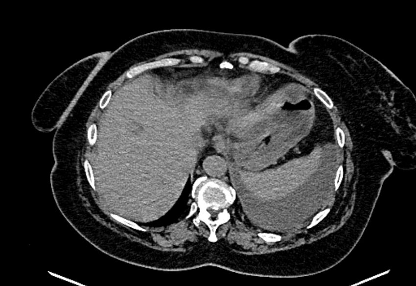 Biliary pancreatitis (Radiopaedia 72289-82823 Axial non-contrast 52).jpg