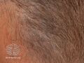 Blue discoloration of scalp skin (DermNet NZ apocrine-chromhidrosis-02).jpg