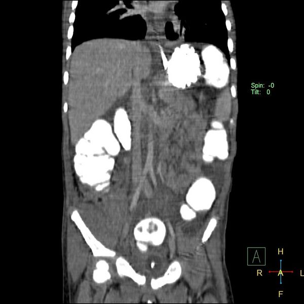File:Blunt abdominal trauma (Radiopaedia 24780-25044 C 11).jpg