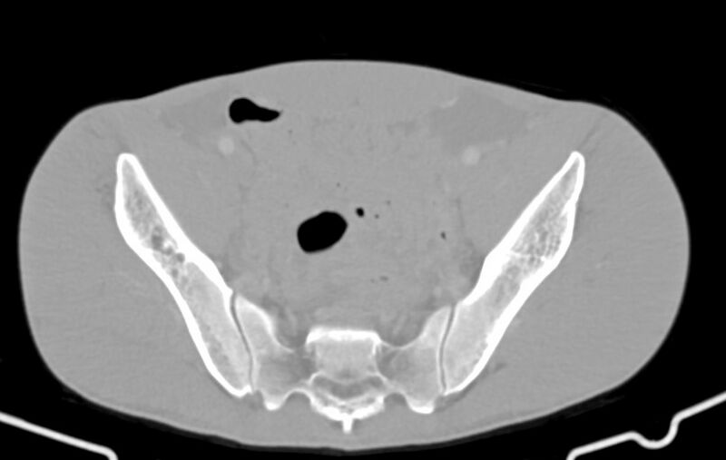 File:Blunt injury to the small bowel (Radiopaedia 74953-85987 Axial Wide 80).jpg