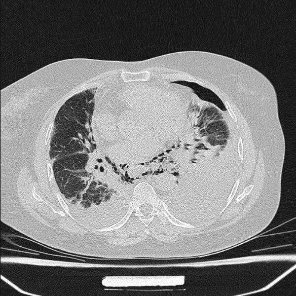 File:Boerhaave syndrome (Radiopaedia 45644-49799 Axial lung window 71).jpg