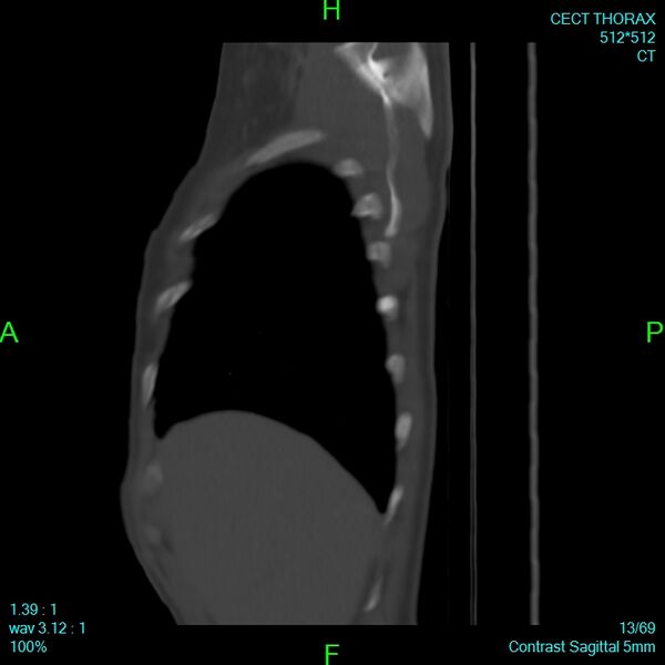 File:Bone metastases from lung carcinoma (Radiopaedia 54703-60937 Sagittal bone window 13).jpg