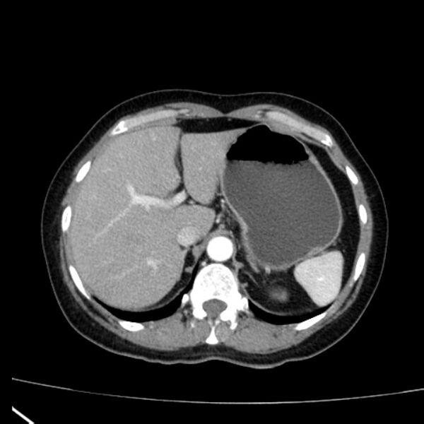 File:Bosniak renal cyst - type I (Radiopaedia 27479-27675 renal cortical phase 15).jpg
