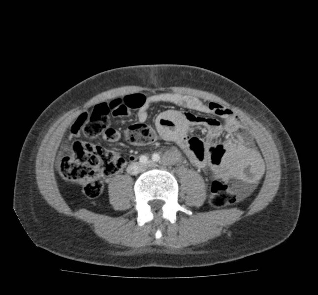 File:Bowel lymphoma complicated by bleeding after therapy (Radiopaedia 55601-62107 A 49).jpg