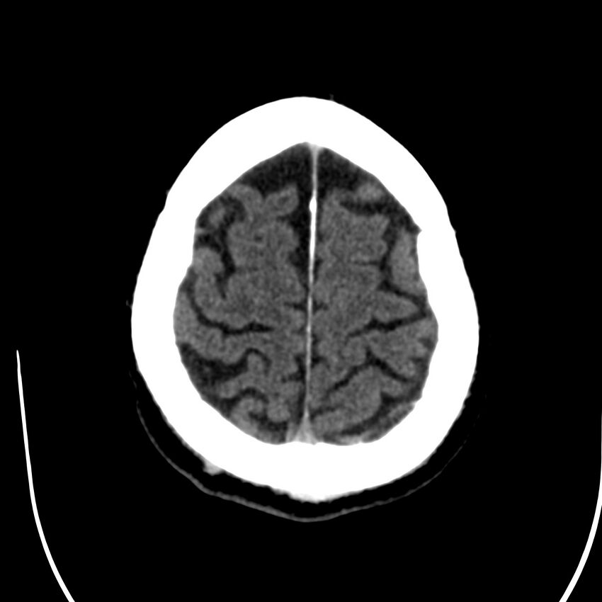 Brain Pantopaque remnants (Radiopaedia 78403-91048 Axial non-contrast 77).jpg