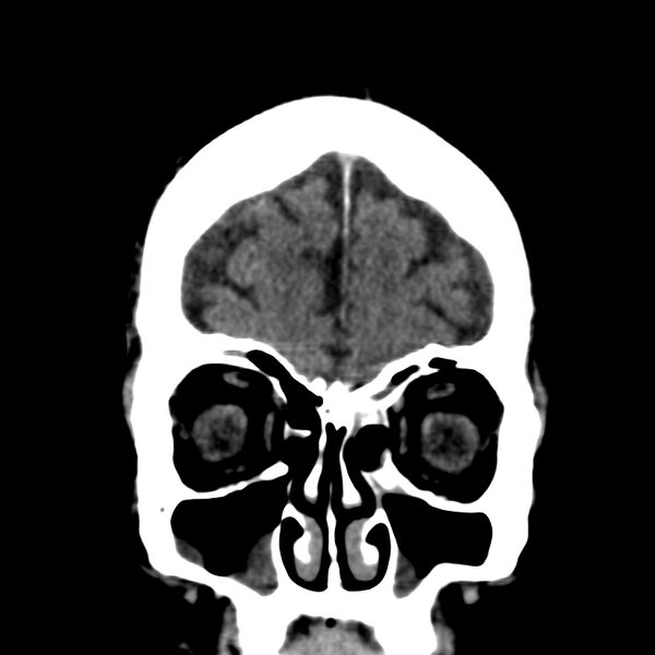 File:Brain Pantopaque remnants (Radiopaedia 78403-91048 Coronal non-contrast 13).jpg