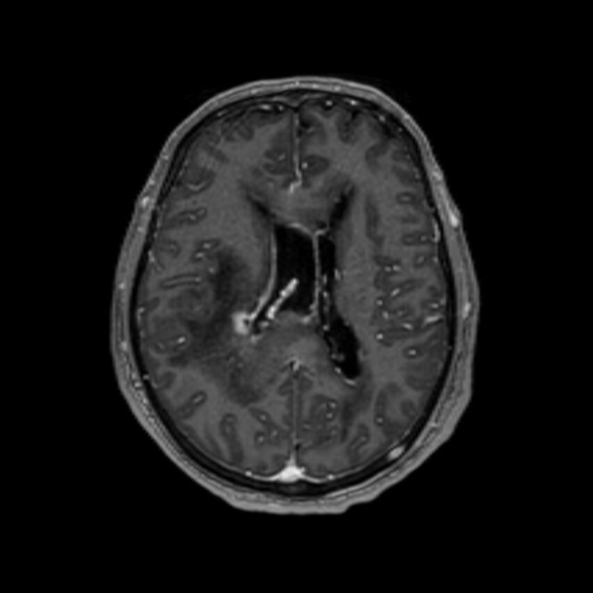 Brain abscess complicated by intraventricular rupture and ventriculitis (Radiopaedia 82434-96577 Axial T1 C+ 41).jpg