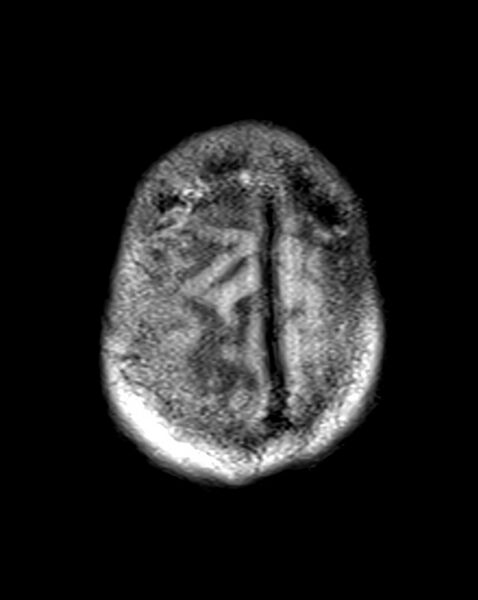 File:Brain abscess with dual rim sign (Radiopaedia 87566-103938 Axial T1 23).jpg