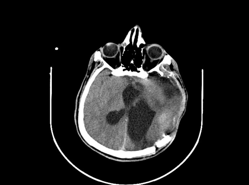 Brain injury by firearm projectile (Radiopaedia 82068-96088 A 127).jpg