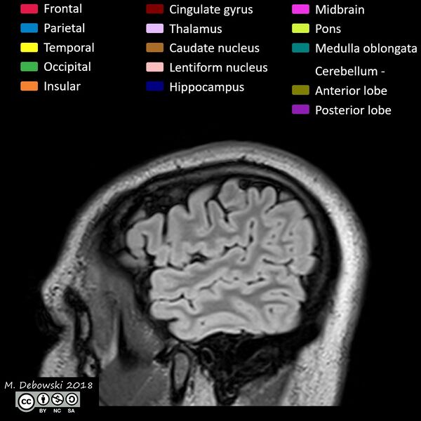 File:Brain lobes - annotated MRI (Radiopaedia 61691-69700 Sagittal 7).JPG