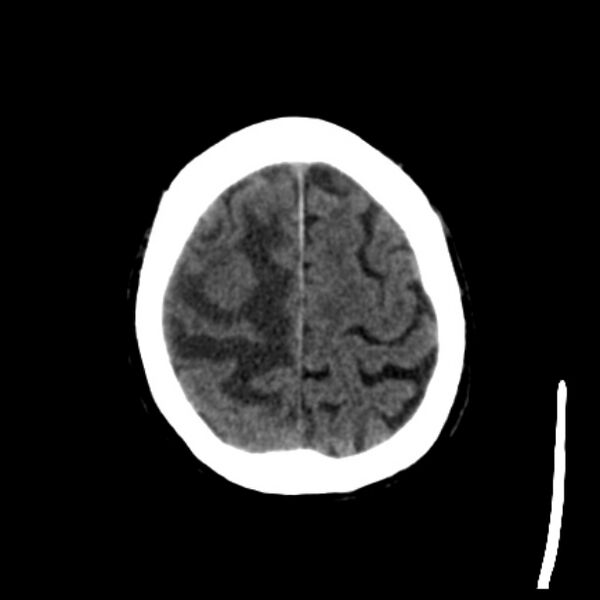 File:Brain metastases from lung cancer (Radiopaedia 27849-28092 Axial non-contrast 39).jpg