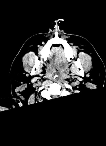 File:Brainstem hemorrhage (Radiopaedia 81294-94976 Axial non-contrast 72).jpg