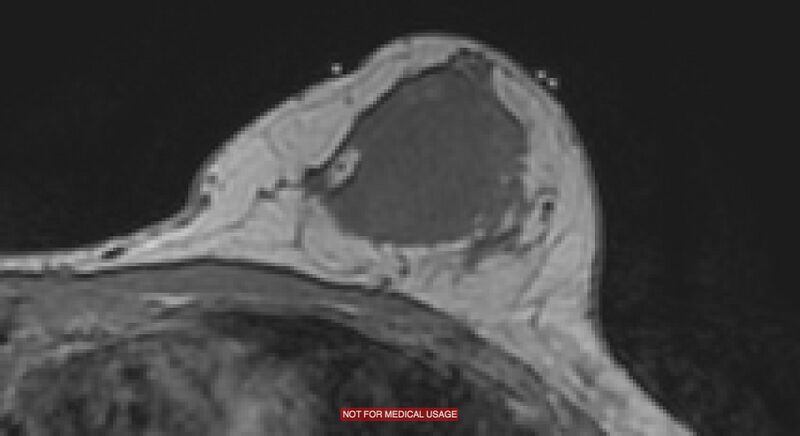 File:Breast lymphoma (MRI) (Radiopaedia 34999-36498 Axial T1 6).jpg
