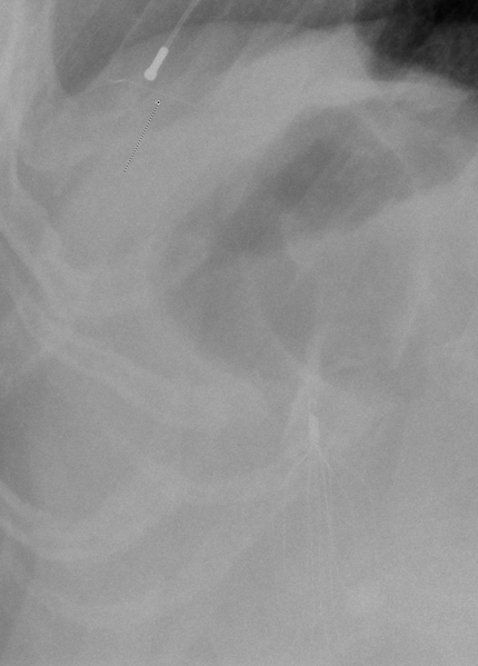 File:Broken appendage of Bard IVC filter (Radiopaedia 41043-43791 Lateral 2).PNG