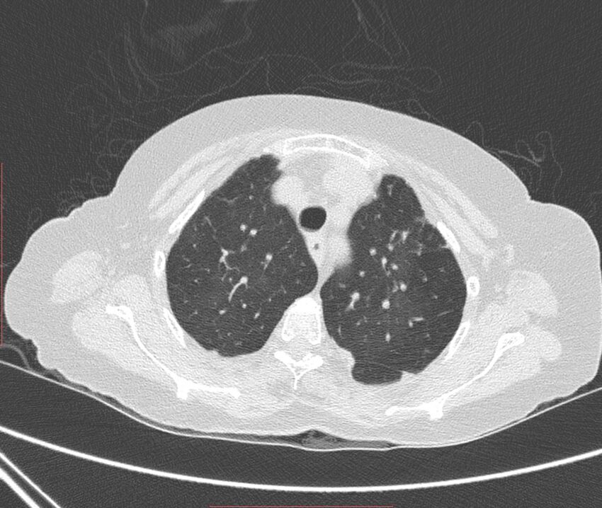 Bronchiectasis (Radiopaedia 72693-83293 Axial lung window 24).jpg