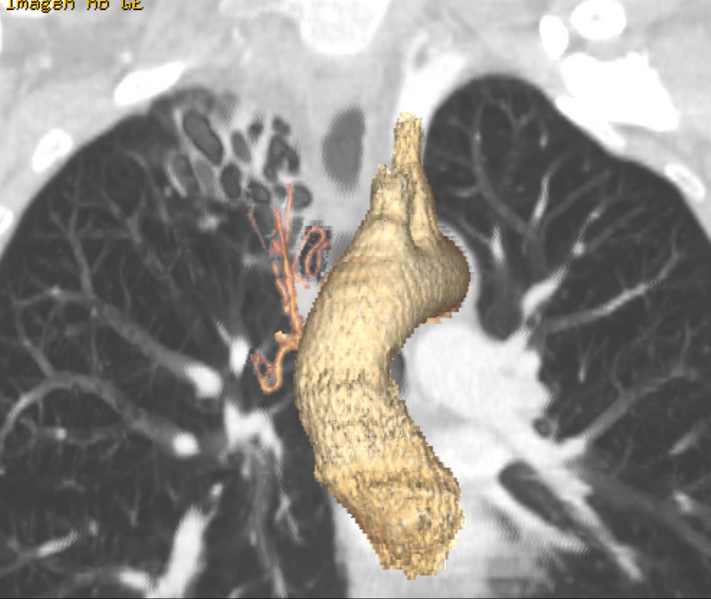 File:Bronchiectasis with bronchial arterial enlargement (Radiopaedia 25148-25417 Coronal lung window 1).png