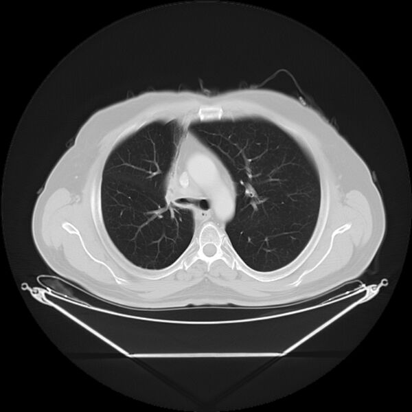 File:Bronchogenic carcinoma with upper lobe collapse (Radiopaedia 29297-29726 Axial lung window 13).jpg