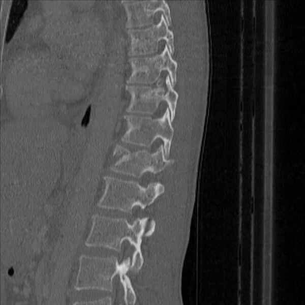 File:Bulging of paraspinal line in traumatic thoracal spinal compression fracture (Radiopaedia 29221-35872 Sagittal bone window 39).jpg