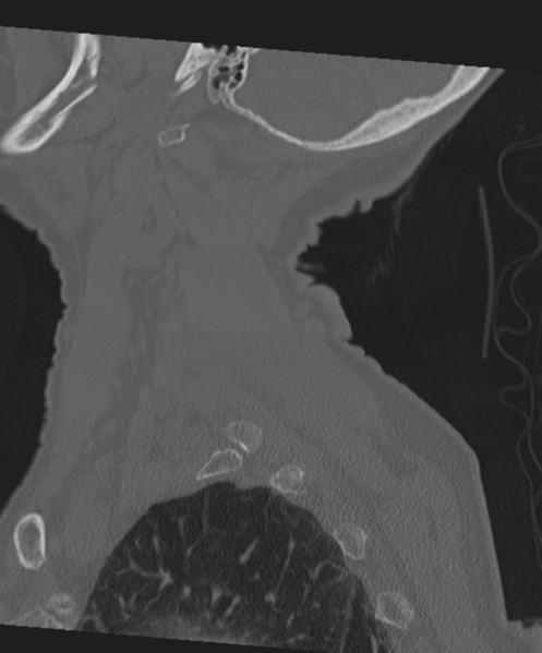 File:C2 fracture with vertebral artery dissection (Radiopaedia 37378-39199 Sagittal bone window 15).png