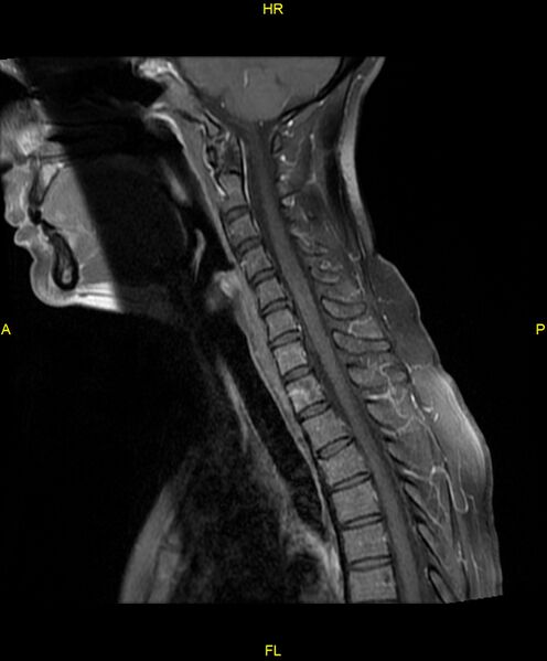 File:C5 nerve sheath tumor (Radiopaedia 85777-101596 F 10).jpg