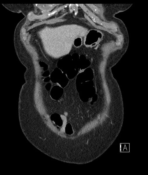 File:Calcified adrenal glands and Spigelian hernia (Radiopaedia 49741-54988 B 16).jpg