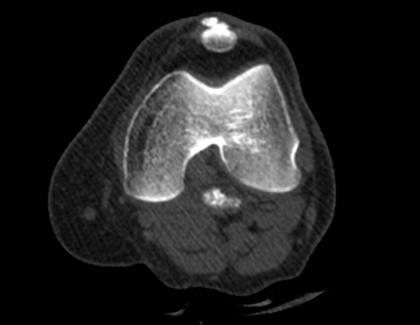 Calcified hematoma - popliteal fossa (Radiopaedia 63938-72763 Axial bone window 6).jpg
