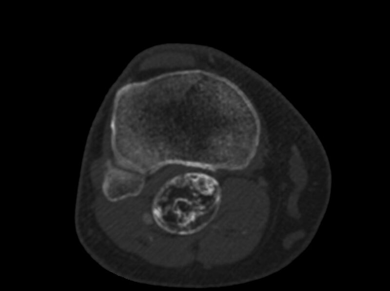File:Calcified hematoma - popliteal fossa (Radiopaedia 63938-72763 C 57).jpg