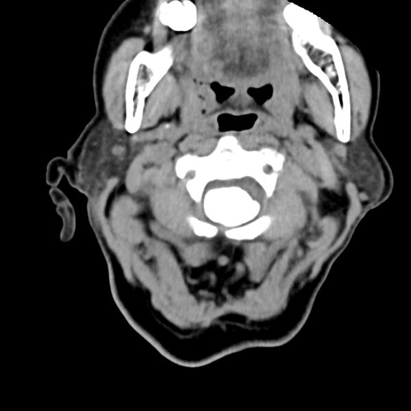 File:Calcified meningioma - cervical canal (Radiopaedia 70136-80171 B 8).jpg