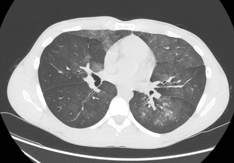 File:Cannabis-induced diffuse alveolar hemorrhage (Radiopaedia 89834-106946 Axial lung window 59).jpg