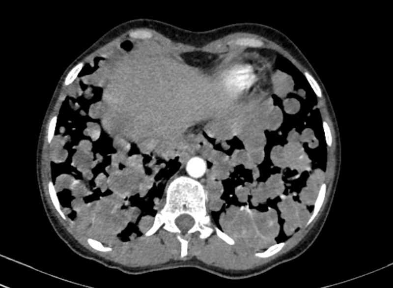 File:Cannonball metastases from breast cancer (Radiopaedia 91024-108569 A 99).jpg