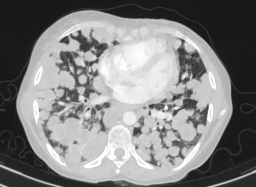 Cannonball metastases from breast cancer (Radiopaedia 91024-108569 Axial lung window 63).jpg