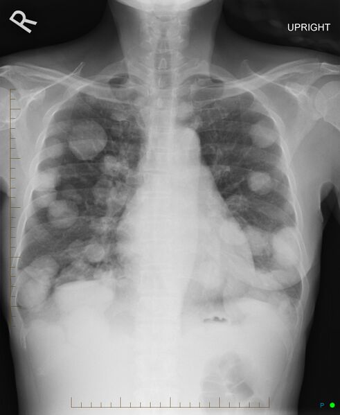 File:Canonball lung metastasis (Radiopaedia 77634-89838 Frontal 1).jpg
