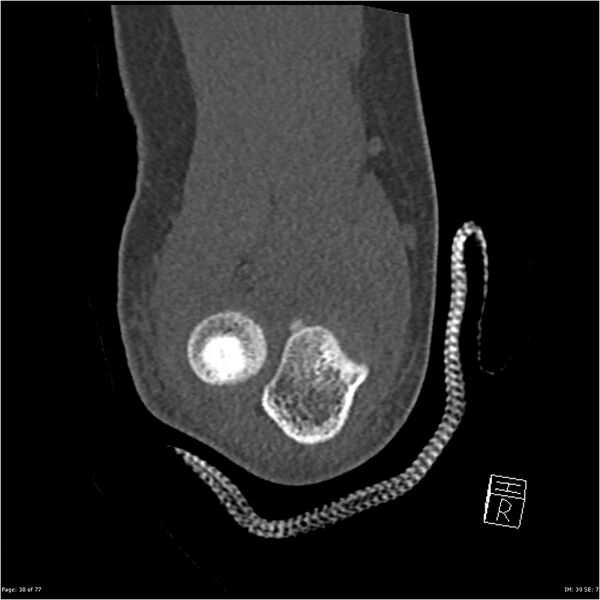 File:Capitellum fracture (Radiopaedia 23352-23426 Coronal bone window 38).jpg