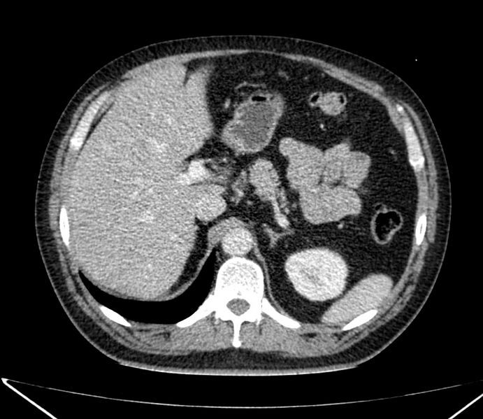 File:Carcinoid tumor with hepatic metastases (Radiopaedia 22651-22670 C 38).jpg