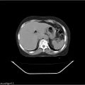 Carcinoma cervix- recurrence (Radiopaedia 34702-36137 B 63).jpg