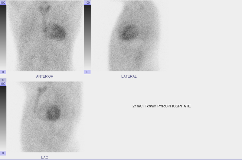 File:Cardiac amyloidosis (Radiopaedia 80704-94149 B 1).PNG