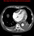 Cardiac perforation following transcatheter aortic valve implantation (Radiopaedia 23714-23863 A 8).png