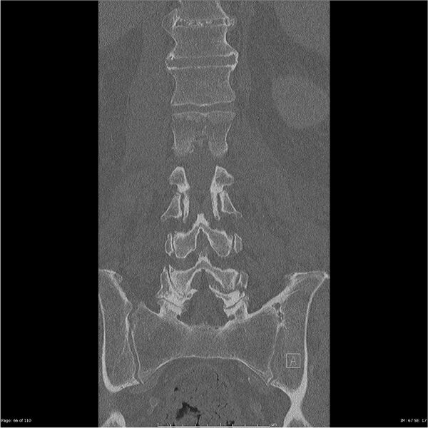 File:Cardiac trauma (Radiopaedia 32874-33858 Coronal bone window 66).jpg