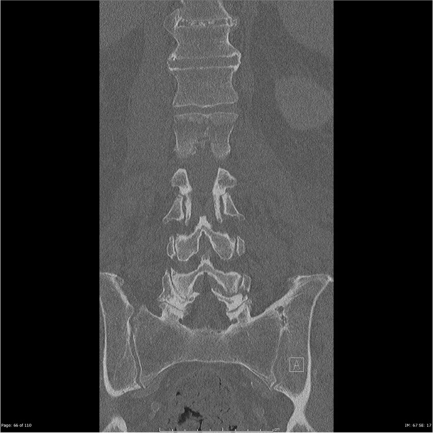 Cardiac trauma (Radiopaedia 32874-33858 Coronal bone window 66).jpg