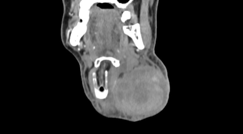 Carotid artery pseudoaneurysm (Radiopaedia 84030-99259 D 15).jpg