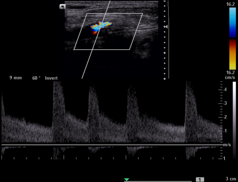 File:Carotid artery stenosis (Radiopaedia 18165-17961 F 1).png