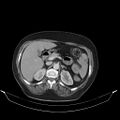 Carotid body tumor (Radiopaedia 21021-20948 A 58).jpg