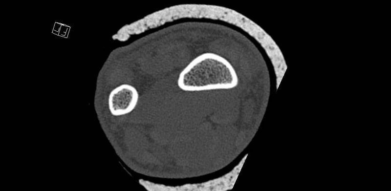 File:Carpal fractures (smart watch impaction) (Radiopaedia 55844-62430 Axial bone window 2).jpg
