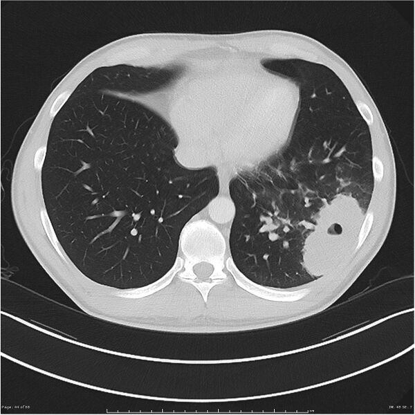 File:Cavitating lung cancer (Radiopaedia 25796-25945 Axial lung window 44).jpg