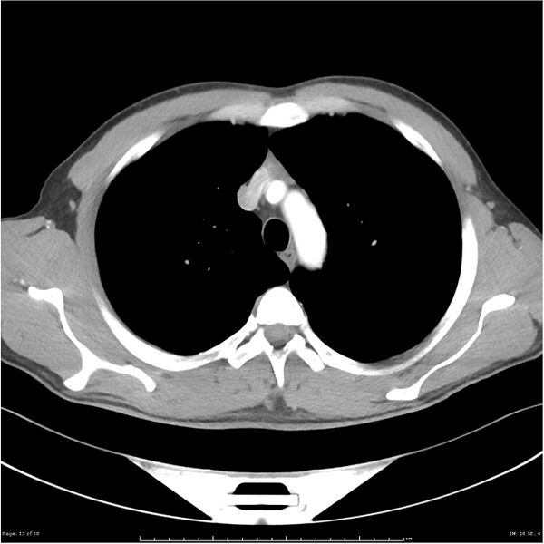 File:Cavitating lung cancer (Radiopaedia 25796-25945 C+ arterial phase 13).jpg