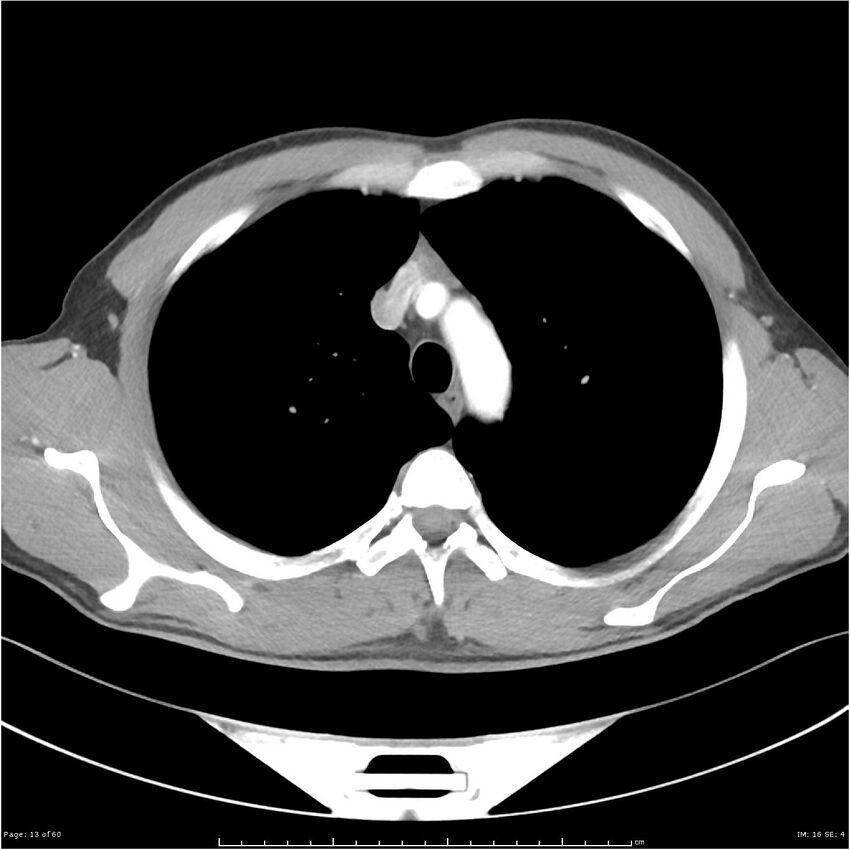 Cavitating lung cancer (Radiopaedia 25796-25945 C+ arterial phase 13).jpg