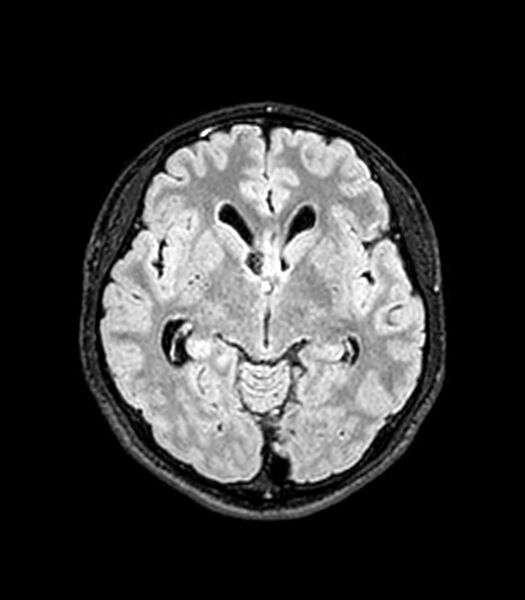 File:Central neurocytoma (Radiopaedia 79320-92380 Axial FLAIR 177).jpg