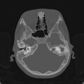 Cerebellar abscess secondary to mastoiditis (Radiopaedia 26284-26413 Axial bone window 54).jpg