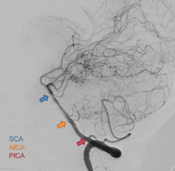 File:Cerebellar arteries (annotated image) (Radiopaedia 36152).jpg
